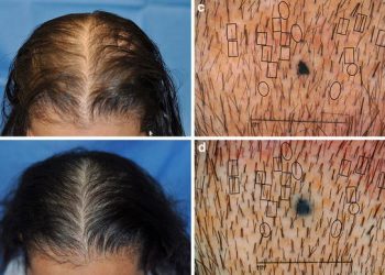 What Is A Laser Helmet And How Can It Help You?